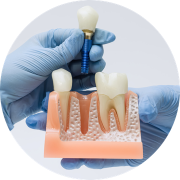 Implantes dentales