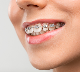 sonrisa con brackets