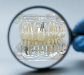 mandíbula con implantes