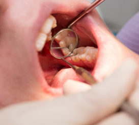 caries